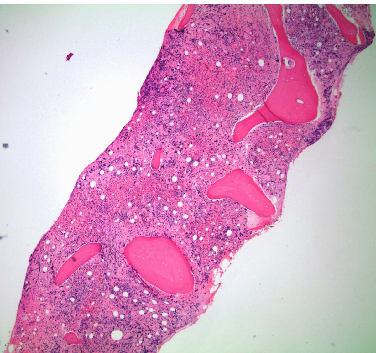 Bone marrow biopsy 40X